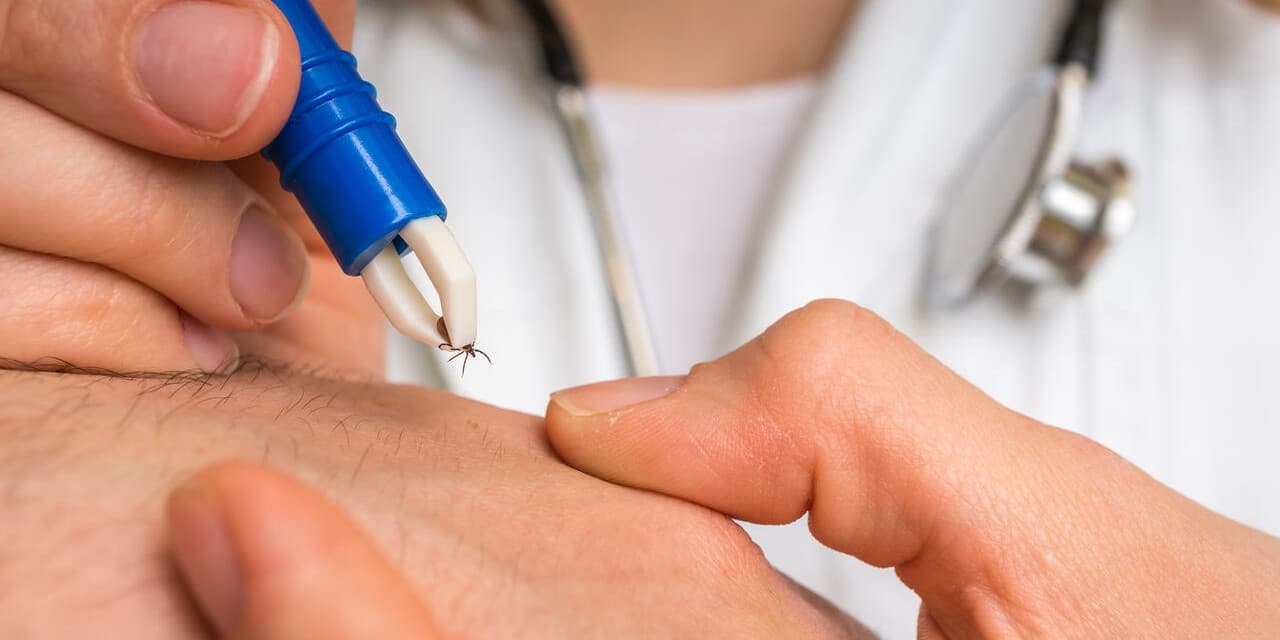 wyciąganie kleszcza - borelioza