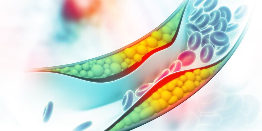 Poziom cholesterolu a ryzyko chorób sercowo-naczyniowych
