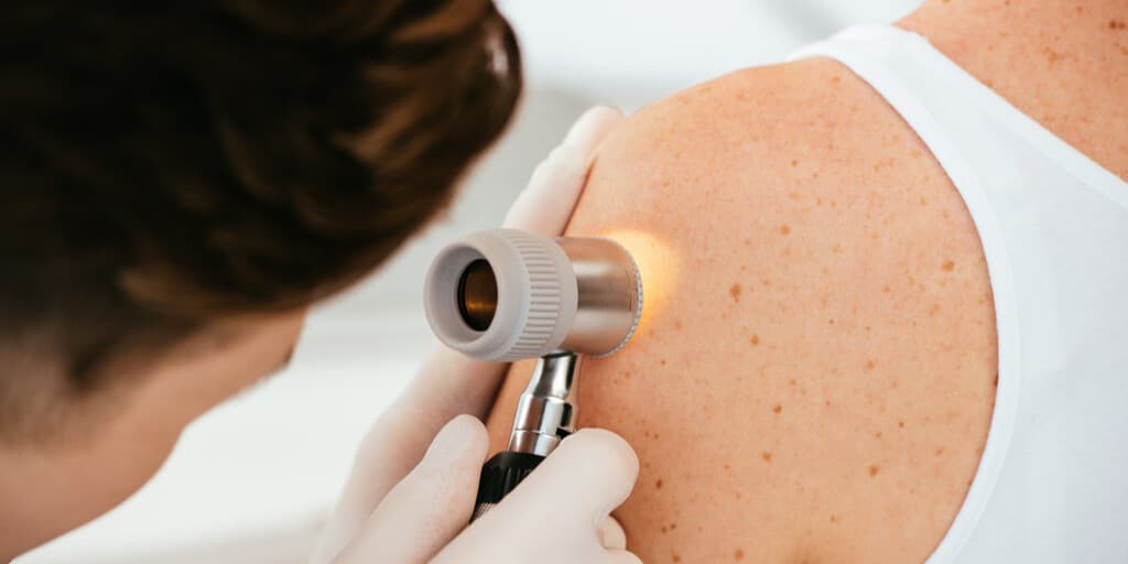 Brodawka łojotokowa a czerniak